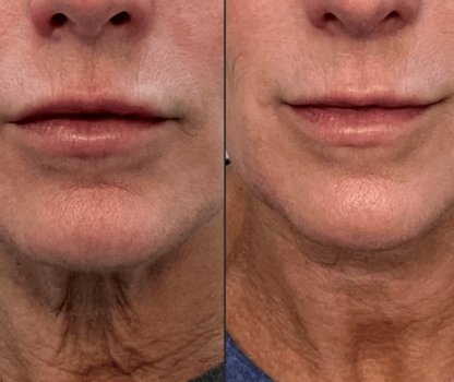 Radiant Renewal 4-in-1 Skincare Wand Kit